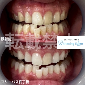 【ご予約はお早めに！】熊本/ホワイトニング