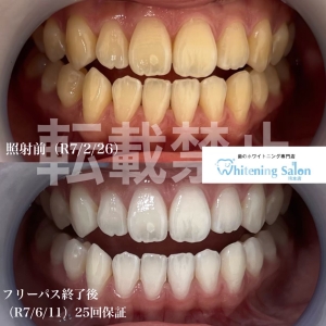 【人気の回数券メニュー】熊本/ホワイトニング