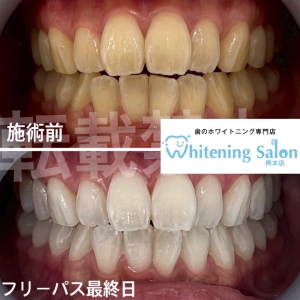 【キシリトールとは】