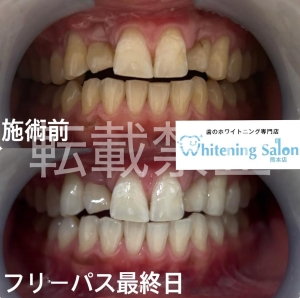 【知覚過敏を予防しよう☆】