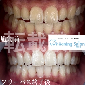 【ホワイトニングの所要時間は？】熊本/ホワイトニング