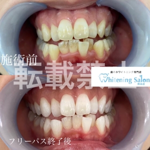 【歯ブラシを交換する理由 】熊本/ホワイトニング