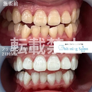 【いびきの原因と治療法】熊本/ホワイトニング