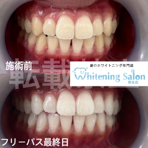 【ドライマウス】熊本/ホワイトニング