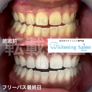 【歯が磨けない時は、うがいだけでも大丈夫？】熊本/ホワイトニング