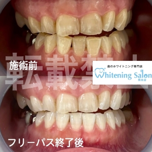 【口内炎を防ごう！】熊本/ホワイトニング