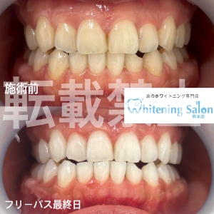 【少しでも白く保つためには？】熊本/ホワイトニング