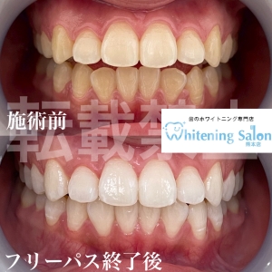 【お口の乾燥の原因とは？】熊本/ホワイトニング