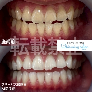 【ホワイトスポットとは？？】熊本/ホワイトニング