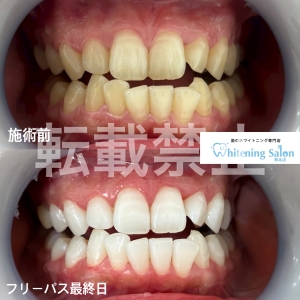 【お忙しい方、イベントを控えている方必見！】熊本/ホワイトニング