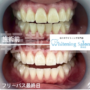 【歯に出来た白い斑点はなに？】熊本/ホワイトニング