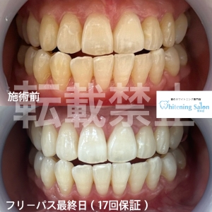 【タバコが歯に与える影響とは?】熊本/ホワイトニング
