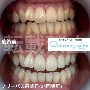 【歯間ケアで歯周病の予防効果UP！】熊本/ホワイトニング