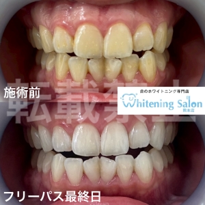 【黄ばみとお酒】熊本/ホワイトニング