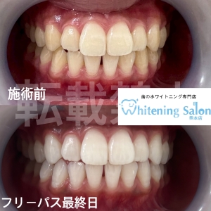 【ホワイト二ングをすると💡】熊本/ホワイトニング