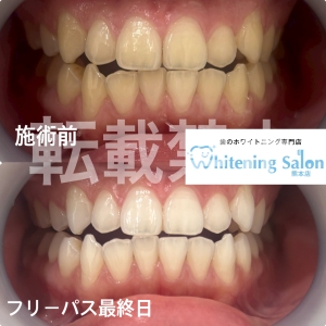 【3ステップでホワイトニング】熊本/ホワイトニング