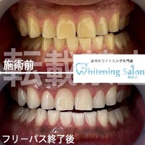 【被せ物も着色はするの？】熊本/ホワイトニング