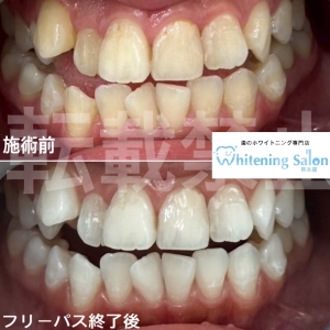 【カルシウムと歯】熊本/ホワイトニング