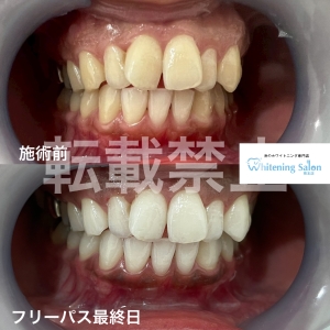 【楔状欠損って何？】熊本/ホワイトニング