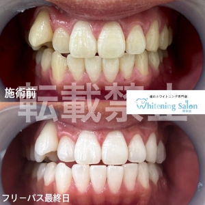 【LINEからもご予約可能です☆】熊本/ホワイトニング